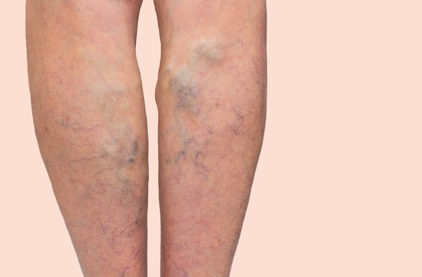 What Complications Can Occur During Varicose Veins?