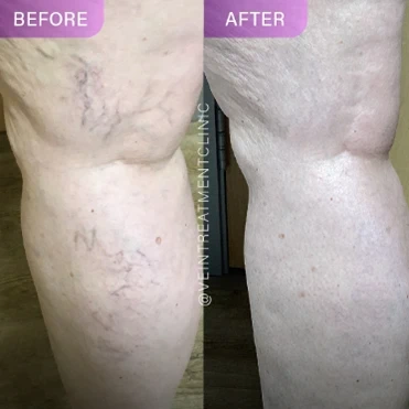 Financial District vein clinic